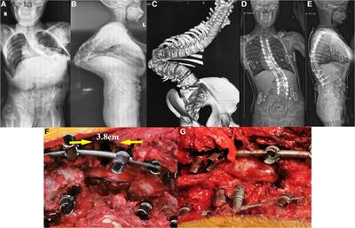 Postoperative dysesthesia after PVCR without anterior support applied in Yang's type A severe spinal kyphoscoliosis